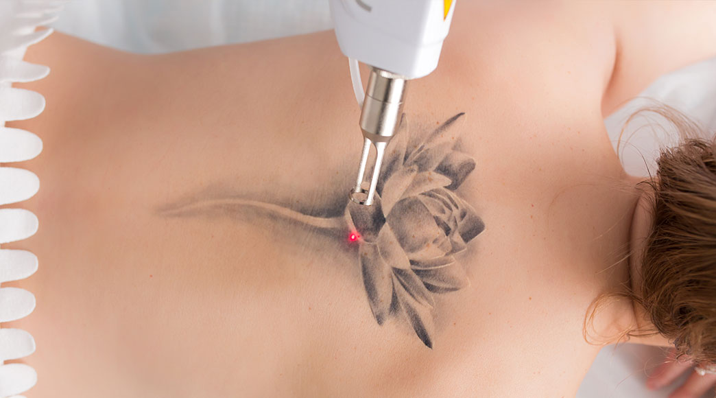 everything-you-need-to-know-about-laser-tattoo-removal