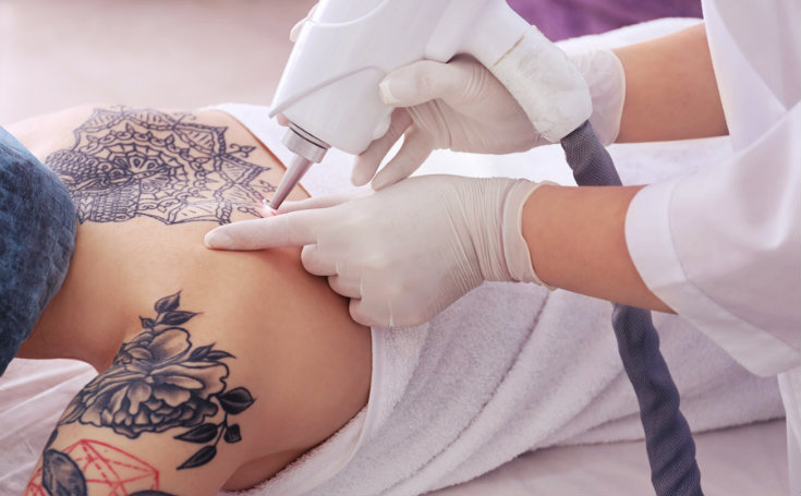 what-you-shouldnt-do-before-your-laser-tattoo-removal-session