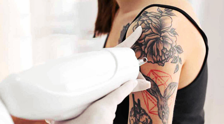 how-laser-hair-removal-affects-tattoos