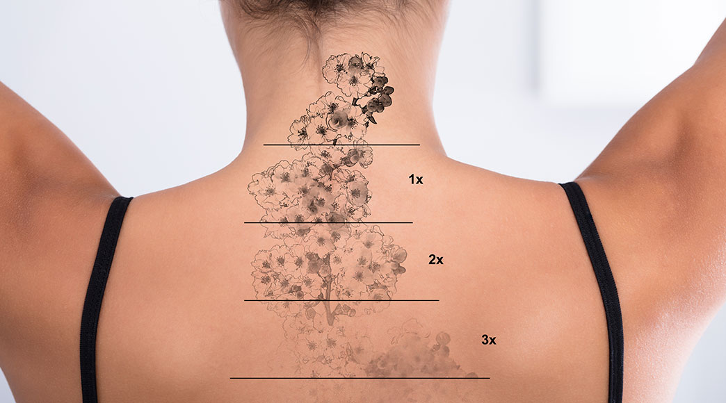 how-to-speed-up-tattoo-removal-and-fading