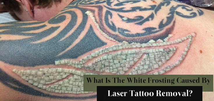 what is the white frosting caused by laser tattoo removal