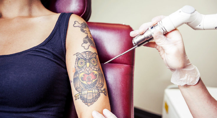 6 most frequently asked questions from tattoo removal patients