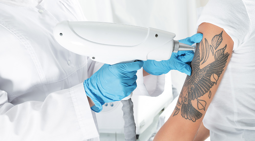 how-effective-is-laser-tattoo-removal