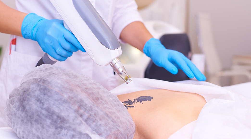 how-to-get-best-results-from-laser-tattoo-removal