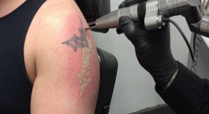 what-does-tattoo-removal-do-to-your-skin