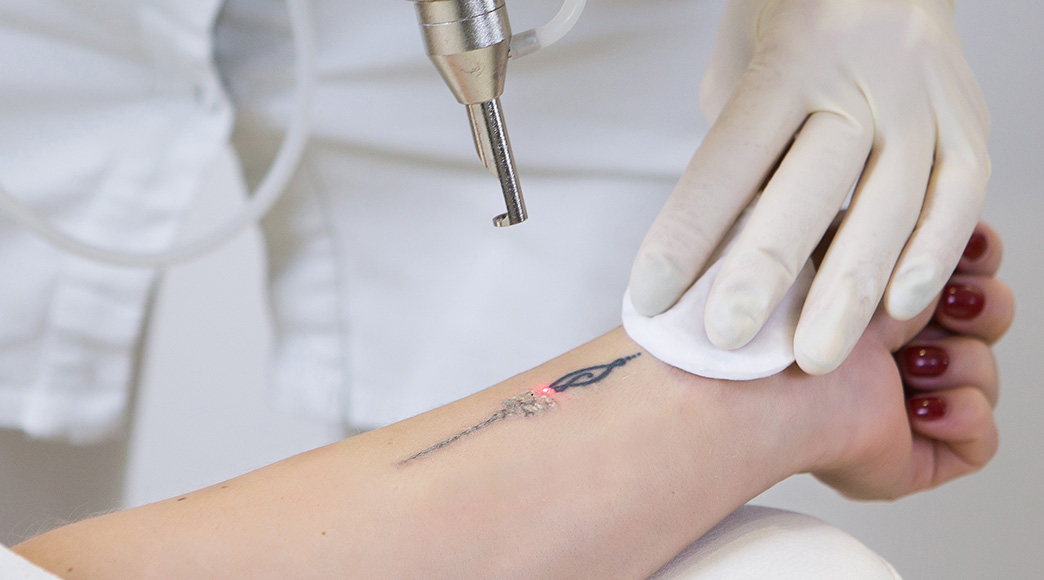 7-things-everyone-gets-wrong-about-laser-tattoo-removal