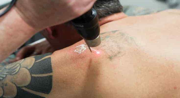 is-laser-tattoo-removal-more-painful-than-getting-a-tattoo