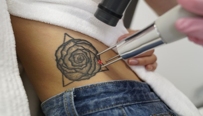 why-do-my-laser-tattoo-removal-results-appear-unsatisfactory