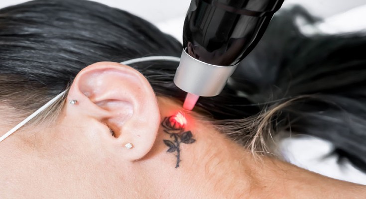 7-things-no-one-tells-you-about-tattoo-removal
