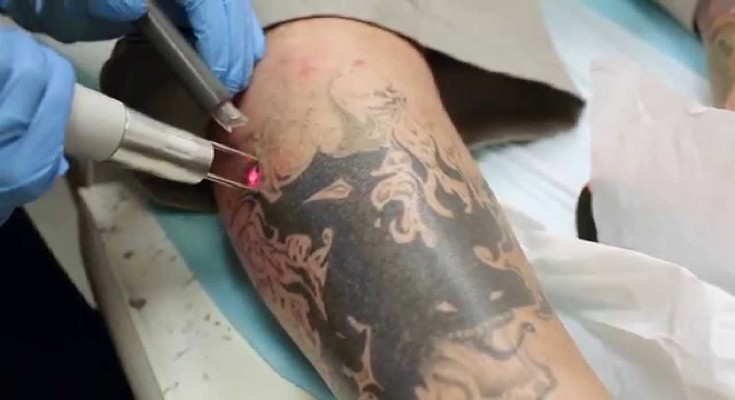 things-to-know-about-large-tattoo-removal