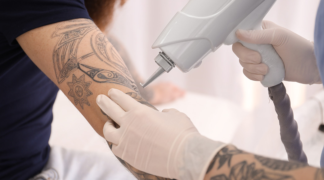 laser-tattoo-removal-procedure-benefits