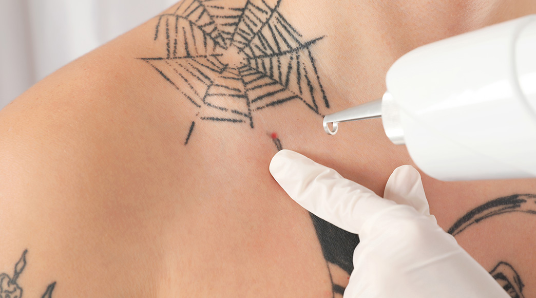 things-to-know-about-laser-tattoo-removal-aftercare