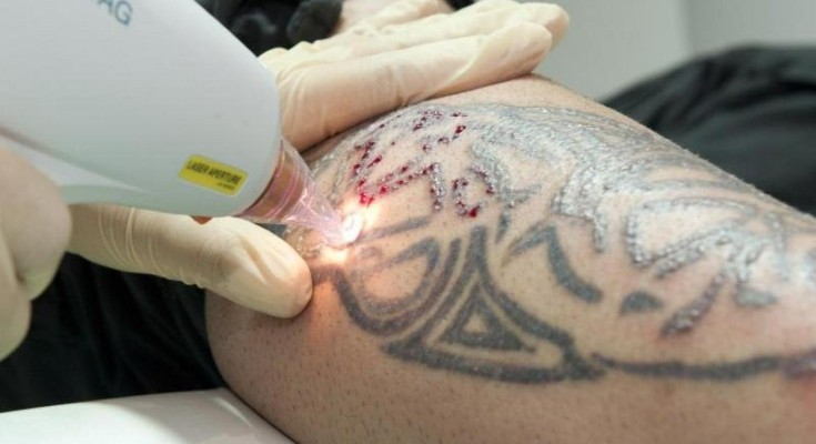 what-exactly-happens-during-laser-tattoo-removal-process