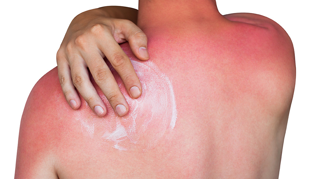 6-ways-to-get-relief-from-sunburn