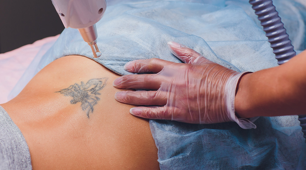 The Myths And Truths Of Laser Tattoo Removal | Fresh Skin Canvas