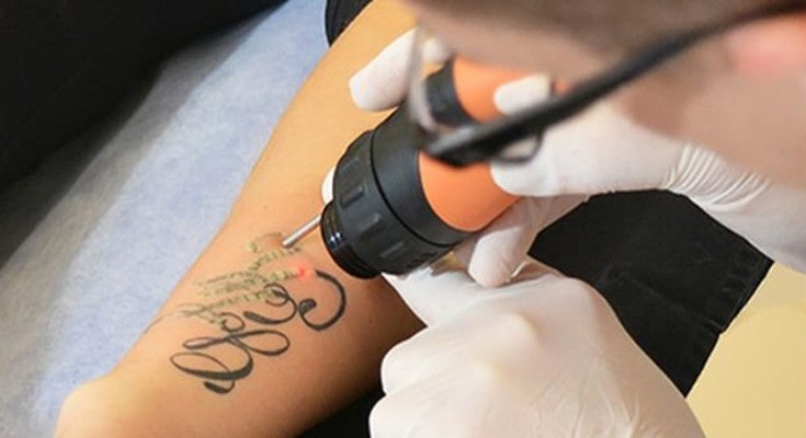 how-sun-exposure-affects-laser-tattoo-removal