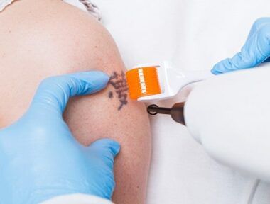 how-to-minimise-risk-during-laser-tattoo-removal