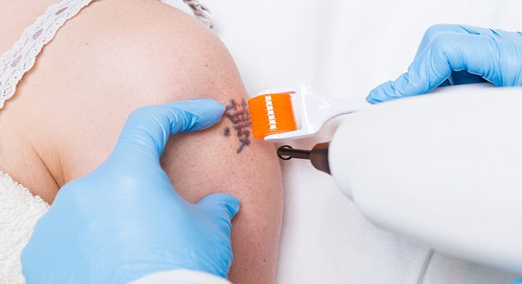 how-to-minimise-risk-during-laser-tattoo-removal