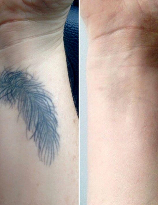 before-after-9