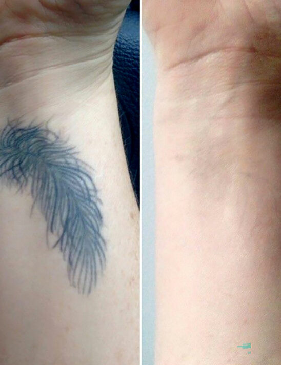 before-after-9
