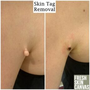 Fibroblast+plasma+skin+tightening+-+skin+tag+removal