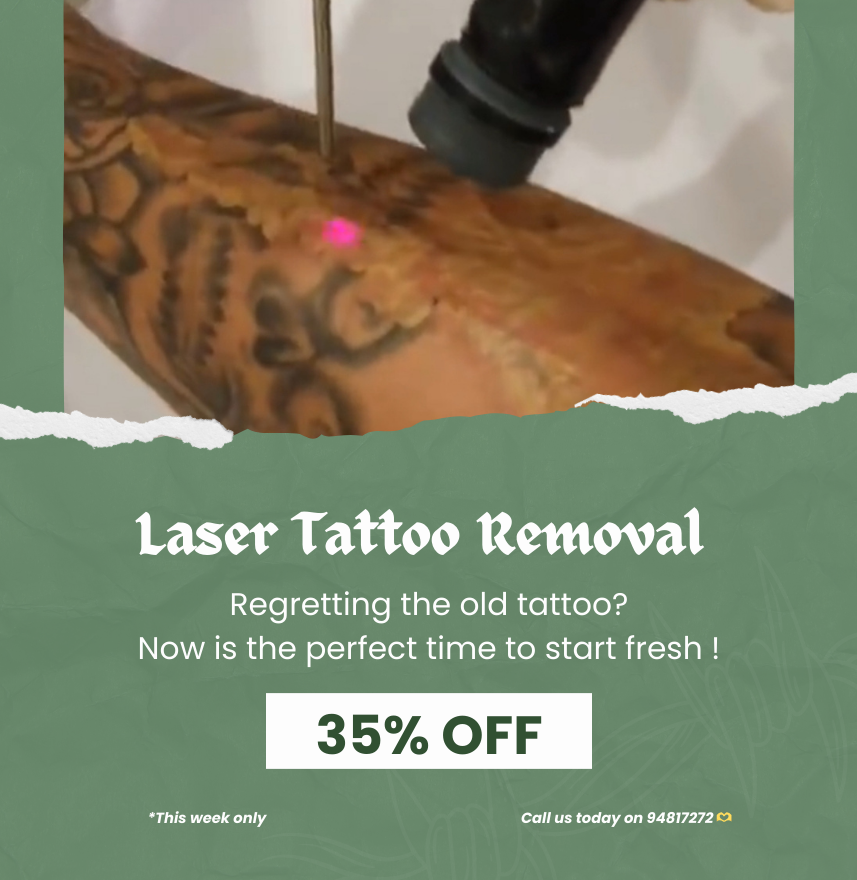 35% off tattoo removal