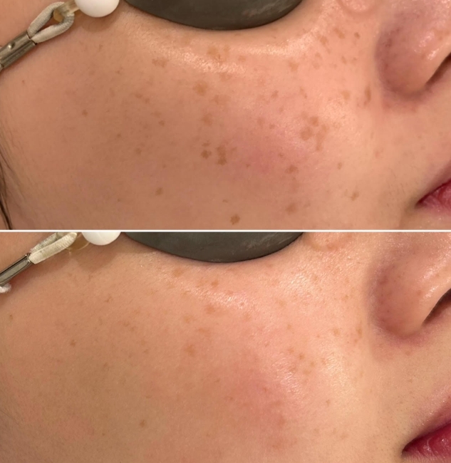 laser-skin-treatment-first-pic-1